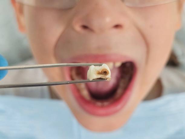 Best Emergency Dental Care for Broken or Chipped Teeth in Perry, UT